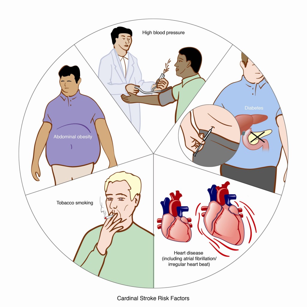 Does blood type affect your stroke risk?