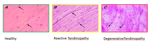 Using load management in the treatment of tendinopathy - Inspire ...